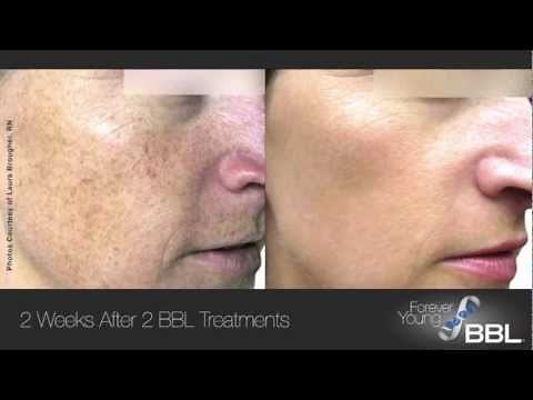 Patient Testimonials | Forever Young BBL™ | Sciton