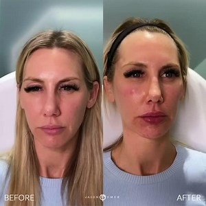 Juvederm Vollure and Voluma to the Cheeks, Chin, Temples, Lips, and Nasolabial Folds | Female Facial Sculpting