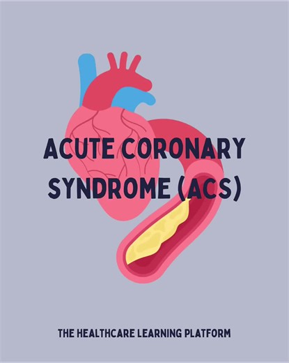 Acute Coronary Syndrome (ACS) is a broad term encompassing unstable angina and heart attacks (myocardial infarction), all of which are caused by a sudden blockage or reduction in blood flow to the heart. This life-threatening condition requires immediate attention and treatment. ⚠️❤️ Key aspects of ACS: Causes: ACS results from a buildup of fatty deposits (plaque) in the coronary arteries, which can rupture or split, forming blood clots that block blood flow to the heart muscle. 🩸🧱 Symptoms: C
