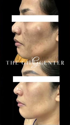 Before and After: Chemical Peel