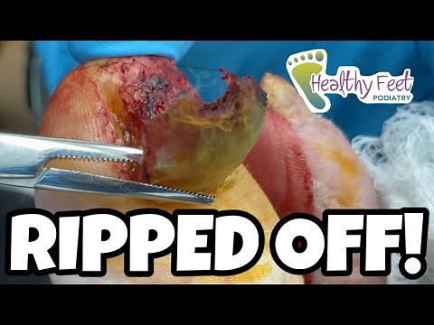 DEVASTATING DIABETIC EMERGENCY! TOENAILS RIPPED OFF BY SOCKS AND THICK FUNGAL TOENAILS TRIMMED!