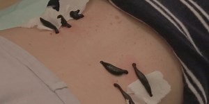 A clinic in Brooklyn offers a 'leech detox' — here's how it works