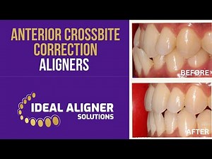 dental crossbite correction - aligners/ ideal aligner solution/custom treatment plan/digital dentist