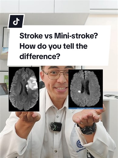 Understanding the Difference Between Stroke and Mini-Stroke