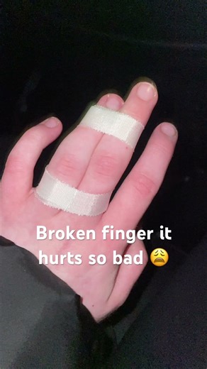 Broken finger 😩🙈 #injury #brokenbones