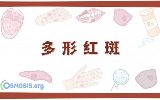 【Osmosis】多形红斑 Erythema Multiforme（中英字幕）