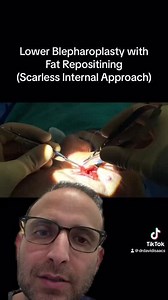 Advanced Lower Blepharoplasty (scarless transconjunctival hidden incision approach) with Fat Repositioning (GRAPHIC)