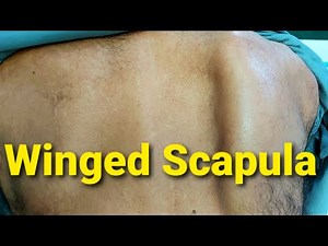Winging of Scapula Video