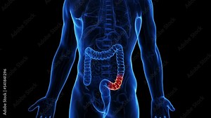 3d rendered medical animation of a man suffering from diverticulitis