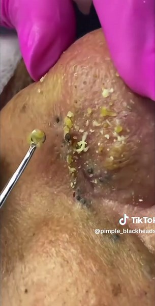 #pimple #blackhead #fyp #viral