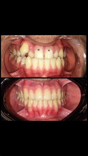 Dr Zeeshan.I.B on Instagram: "D: M/27 Skeletal Class III malocclusion Maxillary Transverse Discrepancy Ant/Post. Cross Bite Highly positioned UR-3 Crowding Rx- Conventional Orthodontics Extraction of LR/LL- 8 Expansion of upper arch with MARPE appliance Distalization of lower arch with TAD's Treatment time : 23 months #invisalign #braces #orthodontist #orthodontic #hyrax"