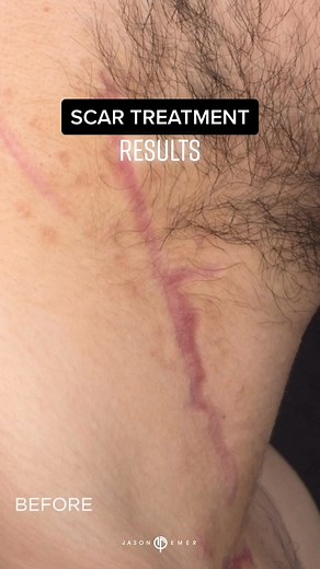 Enhancing Scars with Laser Treatment