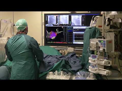 EnSite Precision™ Cardiac Mapping System: Precise, Reliable, Accurate, Fast