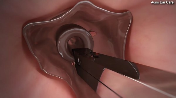 How to remove safely something stuck in your ear canal