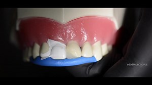 Repair of Fractured Tooth on Dental Model