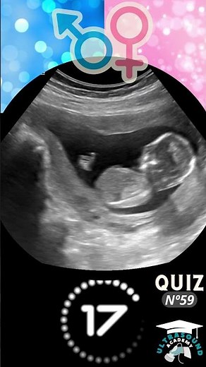 Ultrasound Quiz-59: Can You Guess? Boy or Girl? | Quiz-59 | #ultrasound #babygenderprediction #baby