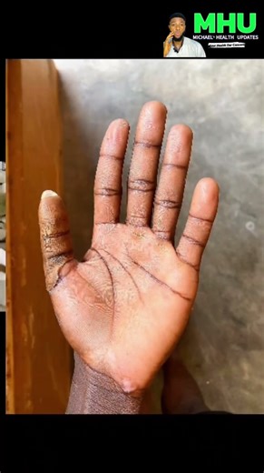 Revolutionary Thumb Prosthesis: Restoring Movement and Confidence!