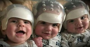 They're the rarest triplets in the world: See what they look like today after historic surgery