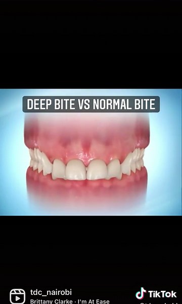 A deep bite is a malocclusion or misalignment of the teeth in which the top front teeth overlap over the bottom teeth. It may also be called an overbite or a closed bite. Deep bites are often caused by a lower jaw that is shorter than the top jaw, causing a serious overlap. Contact us if you think your child suffering from deep bite. Early correction and treatment at right age helps to promote growth of lower jaw and correction of deep bite