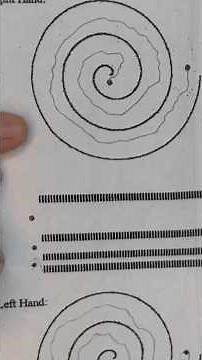 Suggestions For Essential Tremor? #essentialtremor #parkinsonsdisease #vilimball