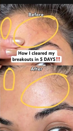 AD | I’ve never been more impressed with an acne treatment 😱 #larocheposaypartner