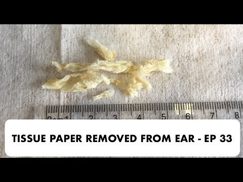 TISSUE PAPER REMOVED FROM EAR - EP 33