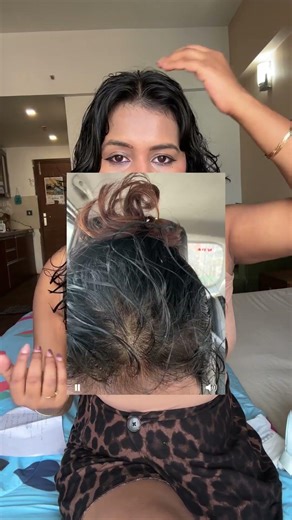 “How I Reduced Hair Fall Fast + My Real Minoxidil Results 🔥”