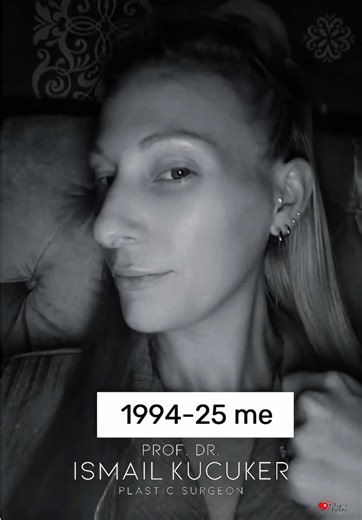 Heidi's 1 Month Post-Op Nose Surgery Update