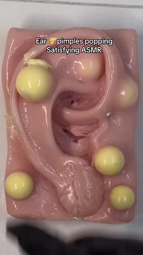 Ear wax cleaning and pimple popping #onthisday #ear #earwax #earcleaning #asmr #satisfying #fypシ #relaxing #diy #cantlookaway #viral