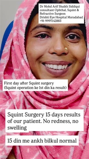 15 din me squint surgery ka behtareen result | no redness no swelling | perfect eye Dr MA Siddiqui