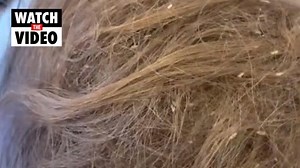 Sydney head lice technician shares 'worst case' ever