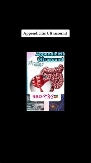 Understanding Appendicitis: Symptoms, Diagnosis, and Treatment