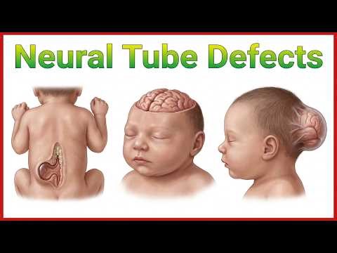 72. Neural Tube Defects Pediatrics | Spina Bifida, Anencephaly & Encephalocele 🧠