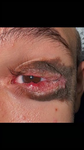 NORTHERNLIGHT EYE CENTER on Instagram: "MELANOCYTIC KISSING NEVUS Melanocytic nevus, a type of nonvascular epidermal nevus, is a benign proliferation of melanocytic cells, which are arranged in nests in epidermis, dermis, or other tissue. The nevi are usually asymptomatic and spare other eye structures, such as conjunctiva, sclera, and cornea. The presenting symptom of eyelid kissing nevus patient is the concern for cosmesis and psychological problems as they cause facial disfigurement and are u