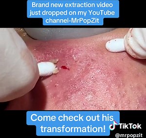 Come see his entire extraction video that just dropped on my YouTube channel-MrPopZit. #medicaleducation #dermatology #skincare #mrpopzit #mrpopzitlive #youtube #youtuber #physicianassociate #skin #popaholic #extractions #acne #acneskin #acnetreatment