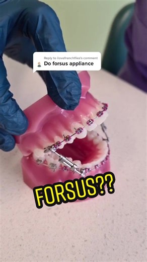 Orthodontic Appliance for Braces: Tips and Advice