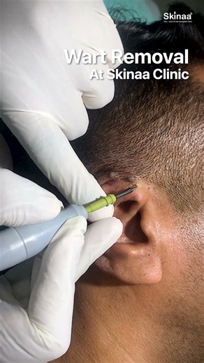 How Warts Are Removed by a Dermatologist | Skinaa Clinic