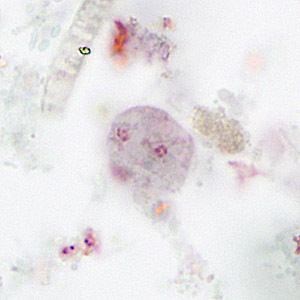 Dientamoeba fragilis - Alchetron, The Free Social Encyclopedia