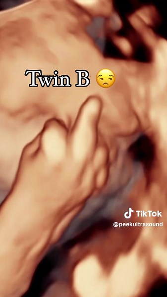 that’s a lot of personality inside one womb 🙈 #identicaltwins #ultrasound #newborn #twinpregnancy #thirdtrimester #pregnant #sonogram #3Dultrasound #exploremore #itsaboy #twins #pregnancy