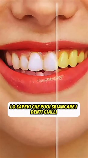 “Lo sapevi che puoi sbiancare i denti in 2 minuti con una semplice buccia di banana?” (Un sorriso bianco come le perle con ingredienti naturali che hai già in casa!) ⸻ 🦷 Ingredienti e dosi: • 🍌 1 buccia di banana (parte interna) → sbianca e lucida i denti in modo naturale • 🍋 1 cucchiaino di succo di limone → aiuta a rimuovere macchie e tartaro • 🧂 1 cucchiaino di sale fino → elimina l’alito cattivo e riduce l’infiammazione delle gengive • 🪥 1 cucchiaino di dentifricio abituale → completa l