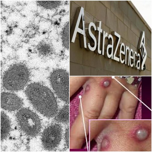 FACT CHECK: Chimpanzee Adenovirus Vector Found in AstraZeneca COVID Vaccine Causes Monkeypox?