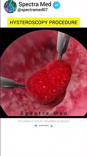 Hysteroscopy Procedure Explained 3D Medical Animation #science #biology