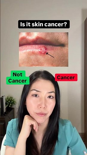 ⚠️ A “cold sore” that doesn’t behave like one… isn’t one.