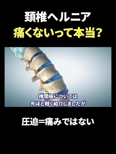 ヘルニアの誤解を解消し、痛みなく生活する方法