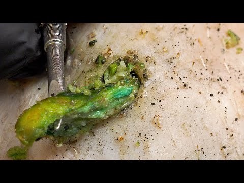 Extremely Long Toenails, Abnormal Growth Of Black Mud | Professional pedicure process【Xue Yidao】1120