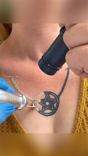 How do they remove a tattoo?