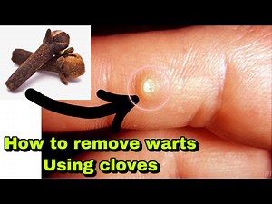 How to remove warts at home [ using cloves ]