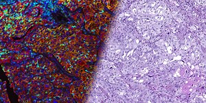 Spatially defining the future of cancer biology with advanced multiplexed immunofluorescence