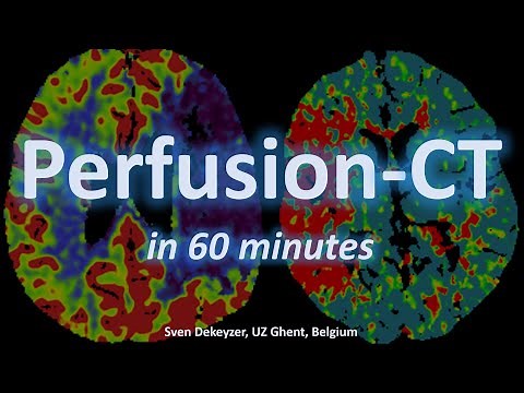 Perfusion-CT in acute ischemic stroke (in ~60 minutes)