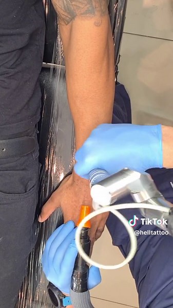 Remoção de Tatuagem em Pele Negra - Resultado Incrível em Poucas Sessões